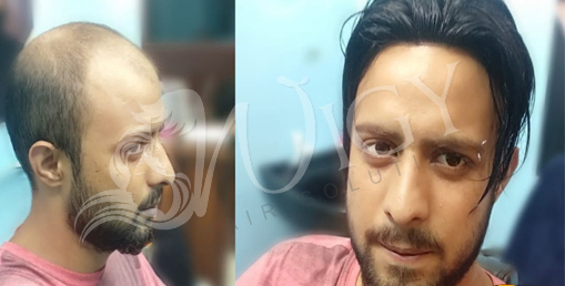 Hair Bonding Service in Delhi