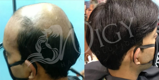 Hair Weaving Service in Delhi