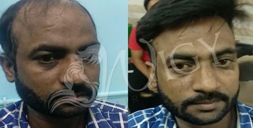 Non Surgical Hair Replacement Service in Delhi