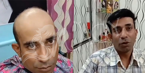 Hair Patch in Delhi